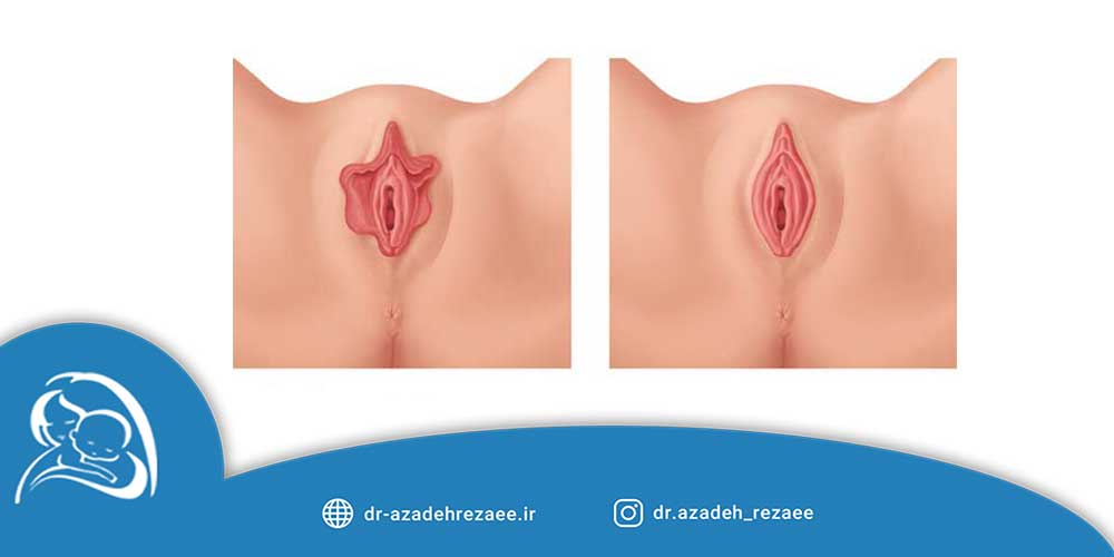 چگونگی انجام جراحی زیبایی واژن بعد از زایمان - مطب دکتر رضایی در تهران