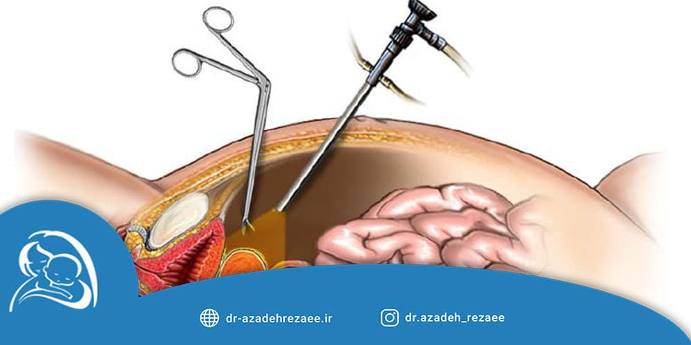 لاپاراسکوپی رحم و تخمدان - مطب دکتر رضایی در تهران